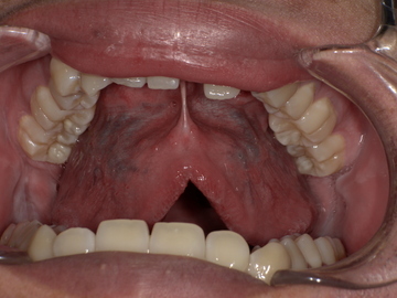 舌小帯切除前　Before