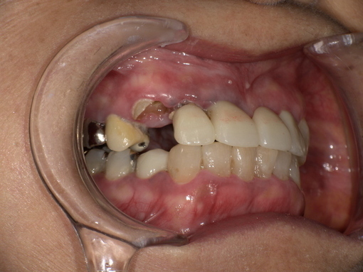 セラミック歯装着前 Before