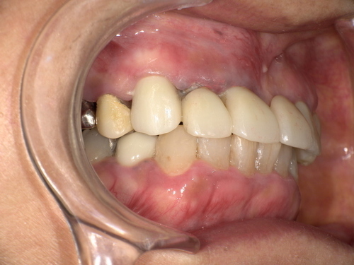 セラミック歯装着後 After
