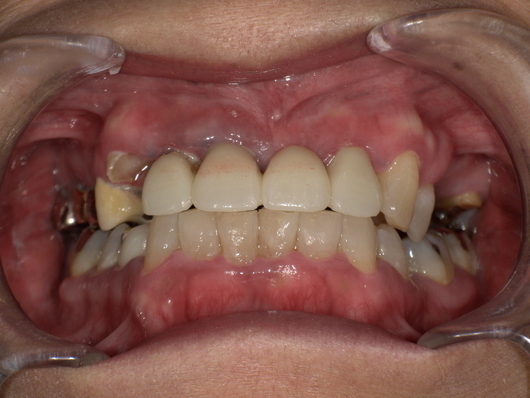 セラミック歯装着前 Before_コピー