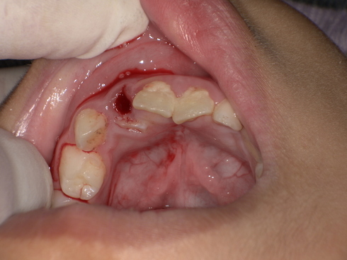 乳歯の抜歯後 After