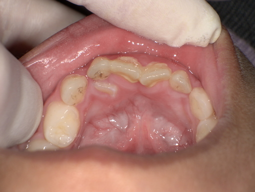 永久歯の舌側転位 乳歯の抜歯前 Before