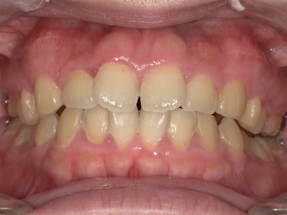 歯ぎしり防止装置装着前　Before