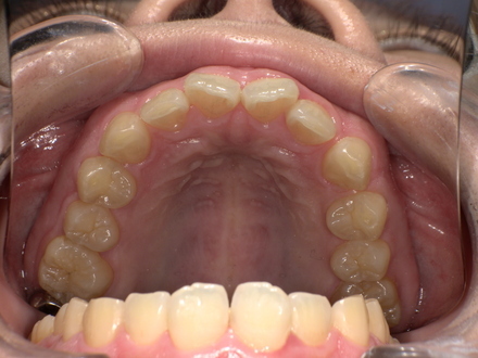 歯ぎしり防止装置装着前　Before