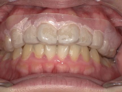 歯ぎしり防止装置装後 After