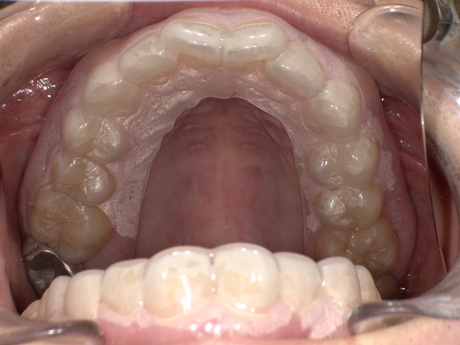 歯ぎしり防止装置装後　After