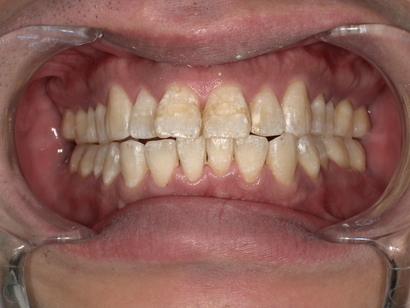 前歯の着色・やにの除去後　After