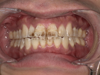 前歯に着色・やに除去前　Before