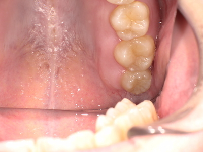 上の親知らず抜歯前Before