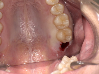 上の親知らず抜歯後After