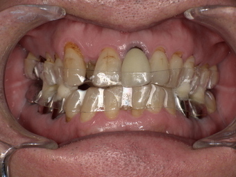 無呼吸症候群のマウスピース装着後 After