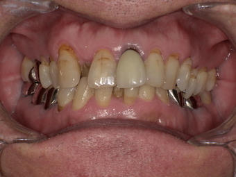 無呼吸症候群のマウスピース装着前 Before