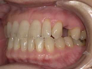 ノンクラスプデンチャー装着前　Before