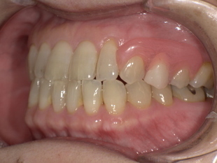 ノンクラスプデンチャー装着後　After