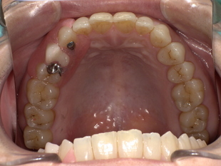 ノンクラスプデンチャー装後　After