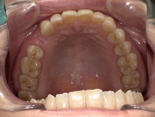 ノンクラスプデンチャー装着前　Before