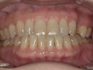 ノンクラスプデンチャー装着前 Before