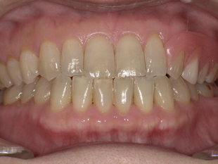 ノンクラスプデンチャー装後 After