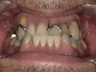 ノンクラスプデンチャー装着後　After
