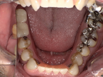 ノンクラスプデンチャー装着後　After