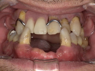 ノンクラスプデンチャー装着前　Before