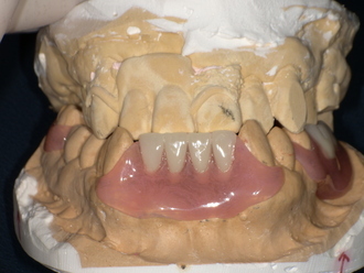 ノンクラスプデンチャー装着後 After