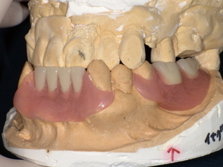 ノンクラスプデンチャー装着後　After