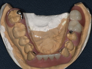 ノンクラスプデンチャー装着後 After