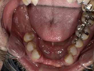 ノンクラスプデンチャー装着前 Before