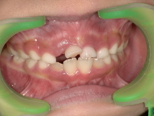 前歯の乳歯抜歯前 Before