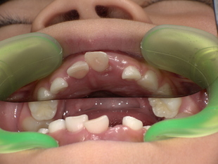 前歯の乳歯抜歯前 Before