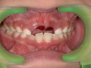 前歯の乳歯抜歯後 After_コピー_コピー