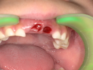 前歯の乳歯抜歯前　Before_コピー_コピー