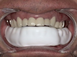 ゴルフ用スポーツマウスガード