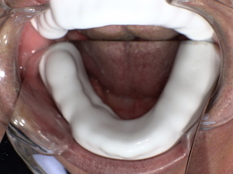 ゴルフ用スポーツマウスガード