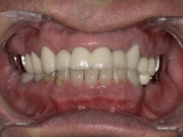 スポーツマウスガード装着前