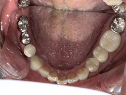 スポーツマウスガード装着前