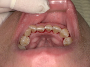 歯石取り後