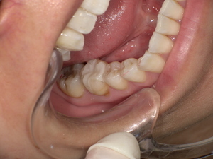 セラミックインレー装着後