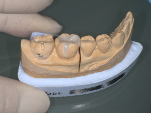 セラミックインレー装着前