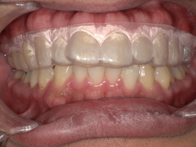 名古屋市天白区のイナグマ歯科による歯ぎしり治療症例After