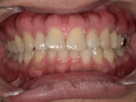 名古屋市天白区のイナグマ歯科による歯ぎしり治療症例Before