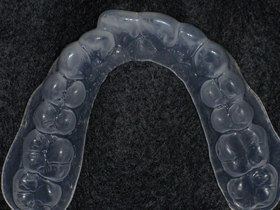 名古屋市天白区のイナグマ歯科による歯ぎしり治療症例の装置・マウスガード