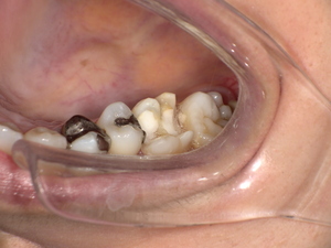 セラミック治療前　Before