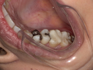 セラミック治療後 After