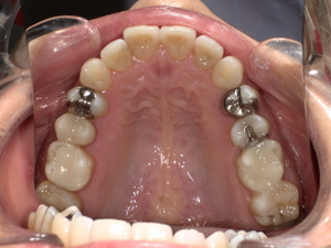 セラミック治療後 After