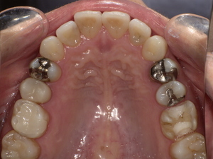 セラミック治療前　Before