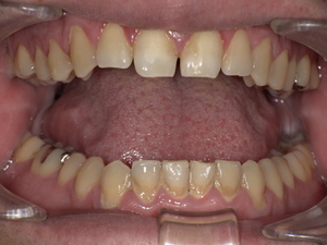 下前歯の表面に歯石が多量に付着し、歯間が閉塞している状態。ブラッシング時に出血が見られる口腔内写真。