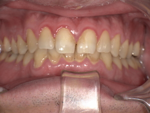 下前歯の表面に歯石が多量に付着し、歯間が閉塞している状態。ブラッシング時に出血が見られる口腔内写真。