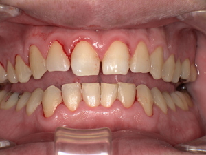 歯石を除去して歯間が正常化し、歯面が滑らかに改善した口腔内の状態。出血が軽減し清掃しやすくなった歯の写真。